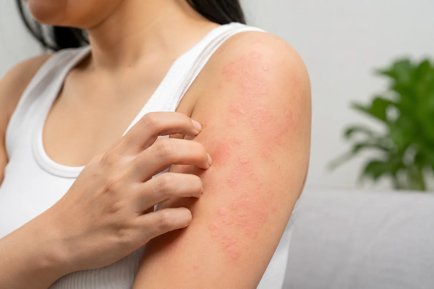 Hives (Urticaria): Causes, Allergy, Stress and When It’s Serious