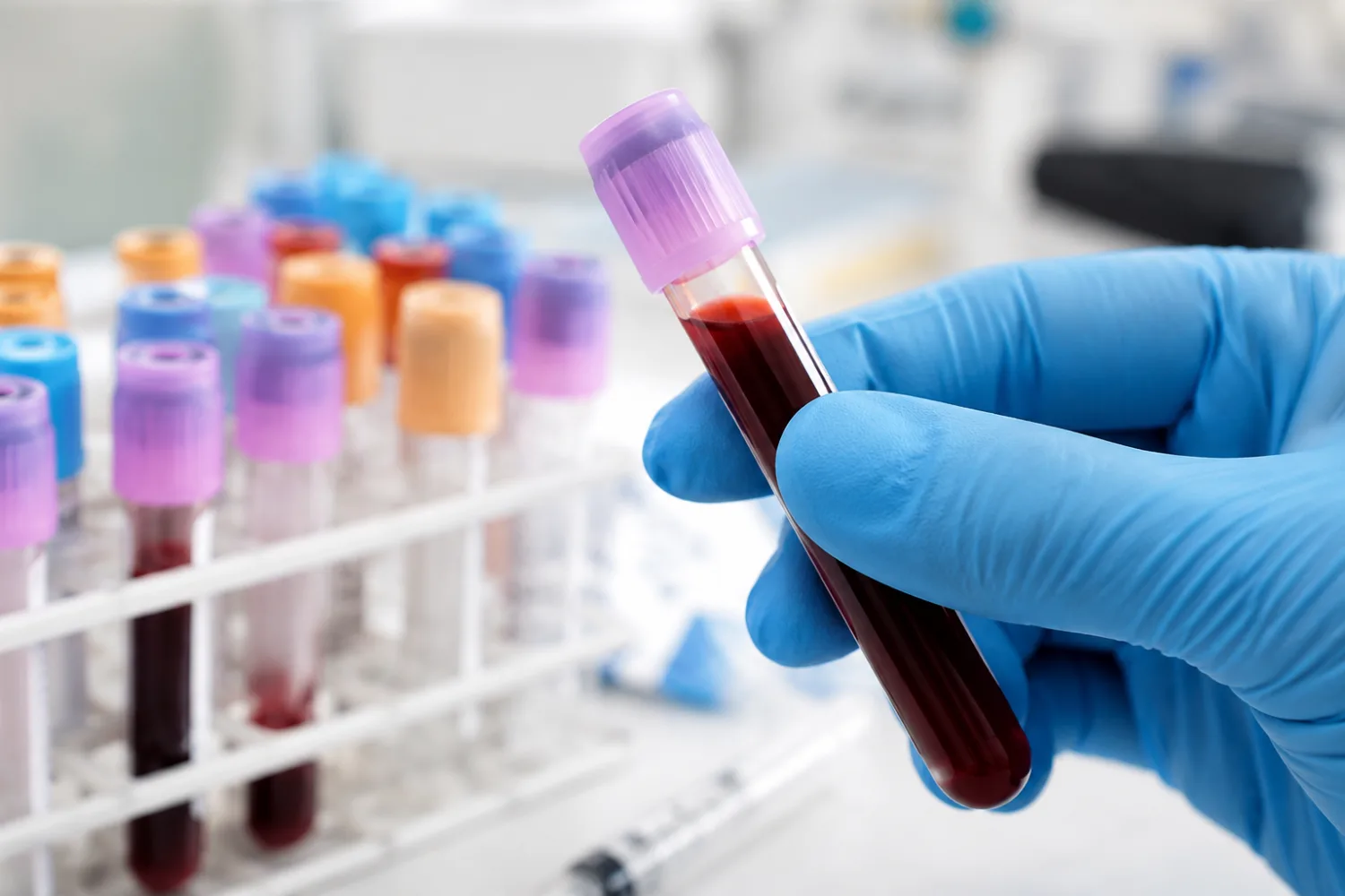 U&E Blood Test Results Explained: Urea, Electrolytes, Creatinine and Kidney Function